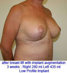 plastic-surgery-breast-lift-augmentation